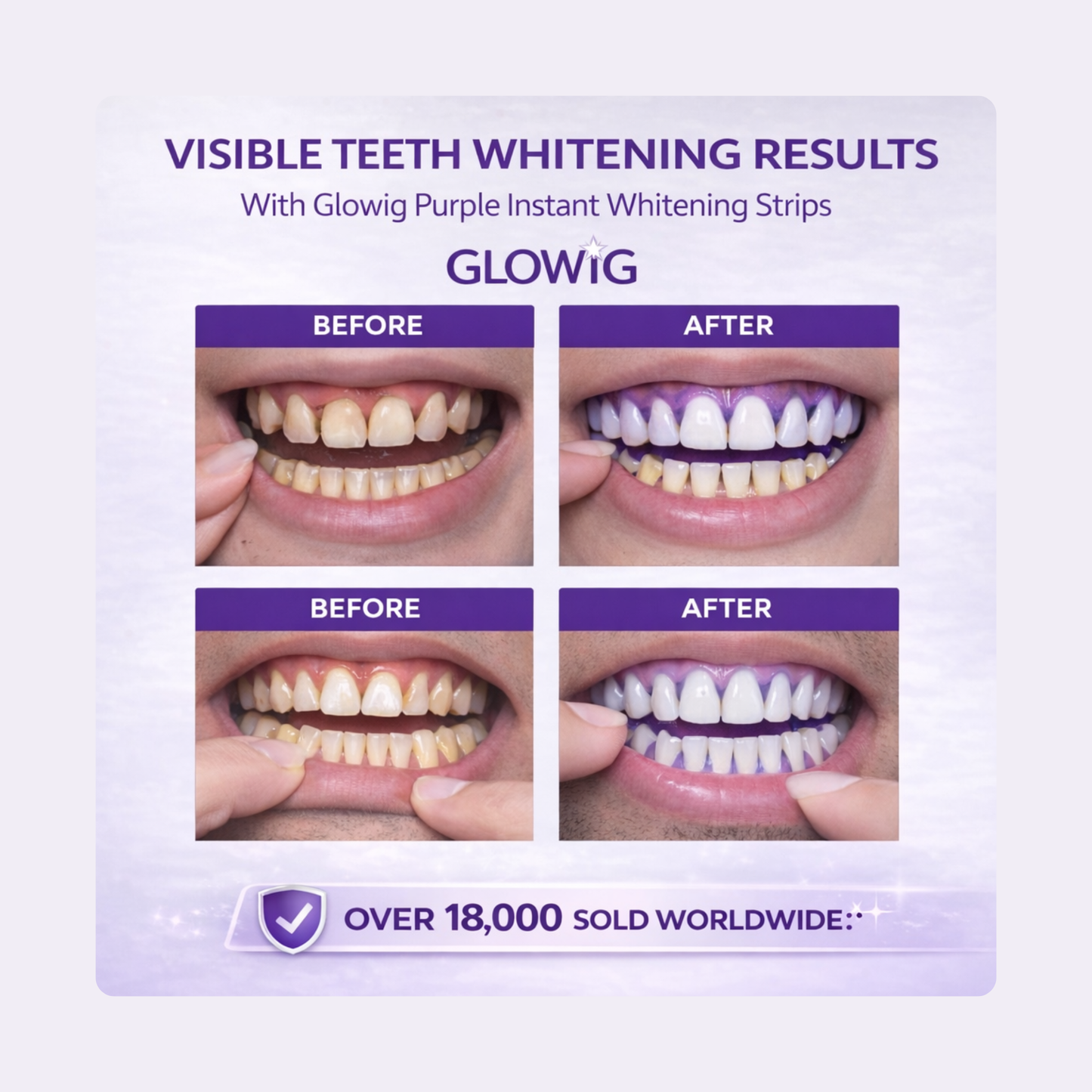 GLOWIG - Whiter Teeth In 30 Minutes